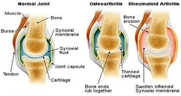 The Best Medicine for Joint Problems, Arthritis, Osteoporosis and Rheumatism