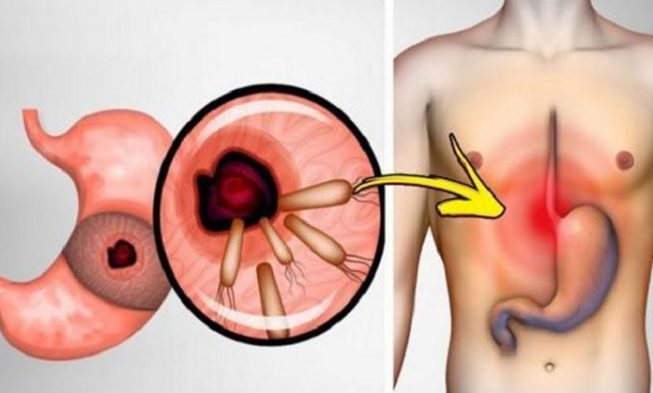 Here Is How To Kill The Bacteria That Cause Heartburn And Bloating